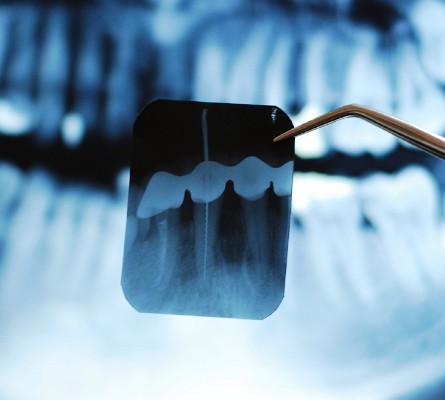 Digital Dental X-Rays, Sault Ste Marie Dentist