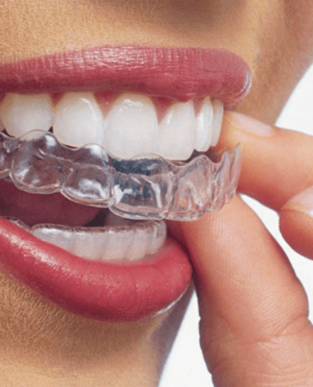 Invisalign Clearn Braces, Sault Ste Marie Dentist