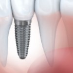 Dental Implants, Sault Ste Marie Dentist